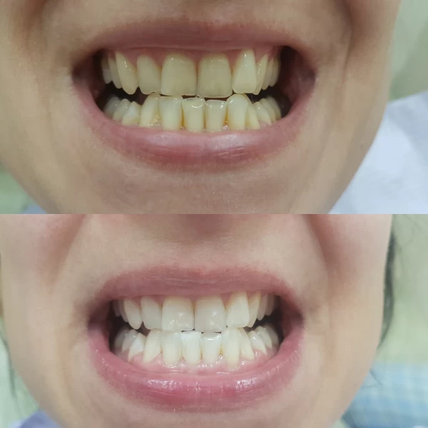 Izbeljivanje zuba - beljenje zuba