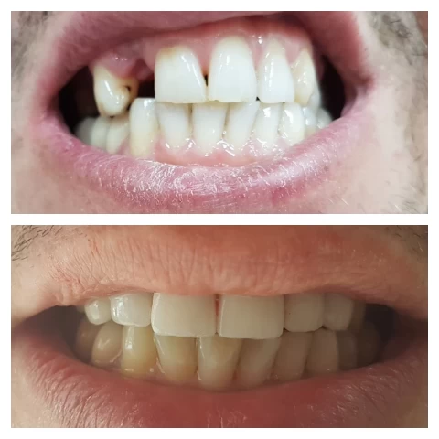 Mostovi - navlake 13