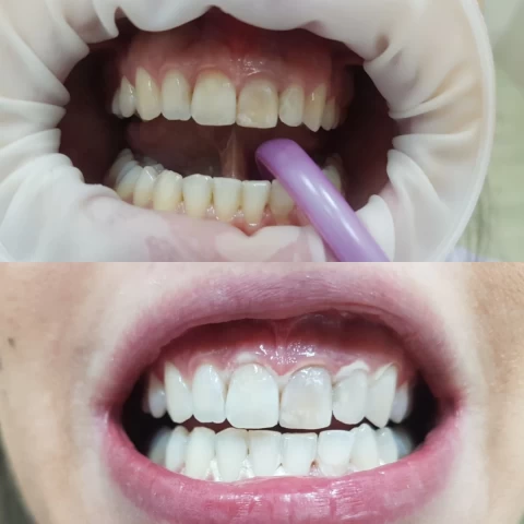 Izbeljenje zuba - beljenje zuba 1