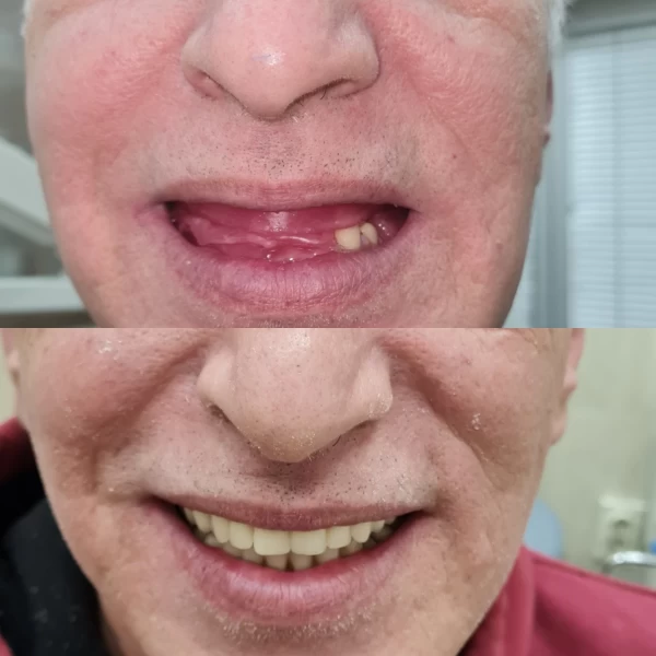 Proteze za zube Proteze za zube