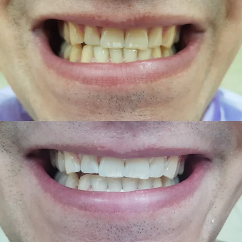 Izbeljenje zuba - beljenje zuba 3