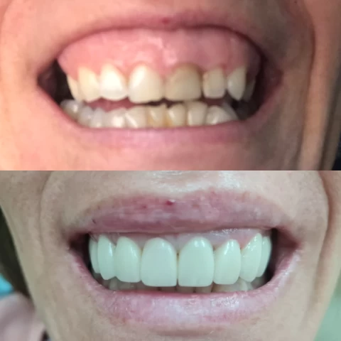 Mostovi - navlake 15