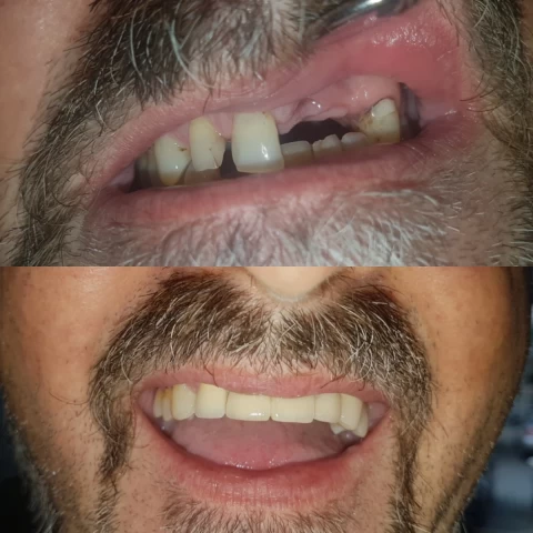 Mostovi - navlake 12