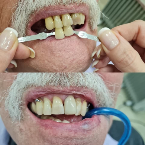 Proteze za zube Proteze za zube 1