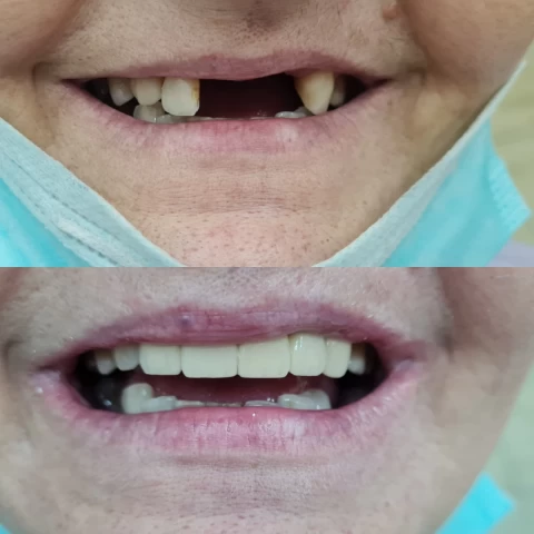 Mostovi - navlake 16