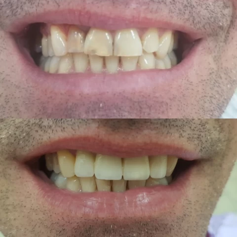 Mostovi - navlake 11