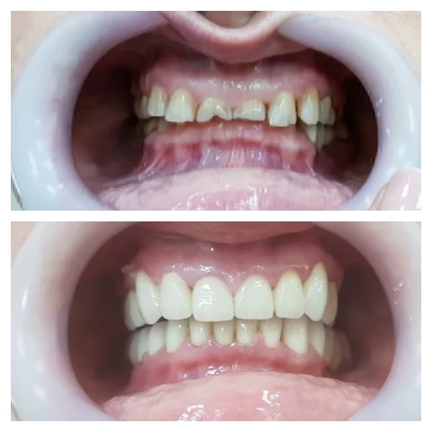 Mostovi - navlake 14