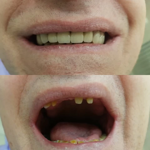 Mostovi - navlake 10